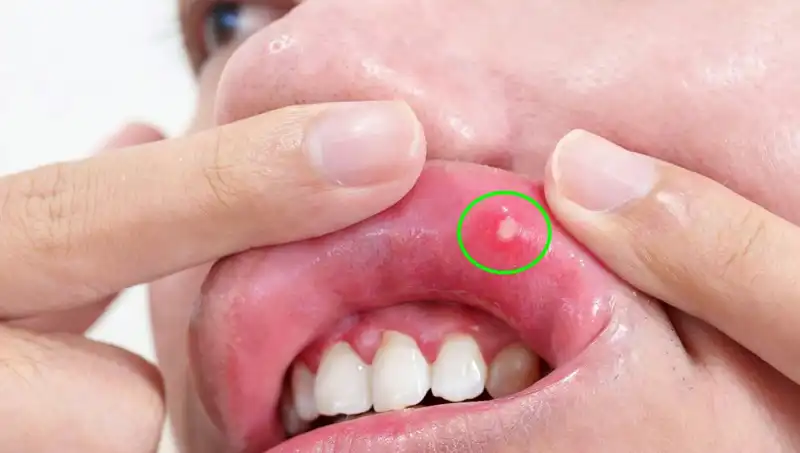 Kanserin İhmal Edilen Belirtileri: Dil Alımının Hikayesi